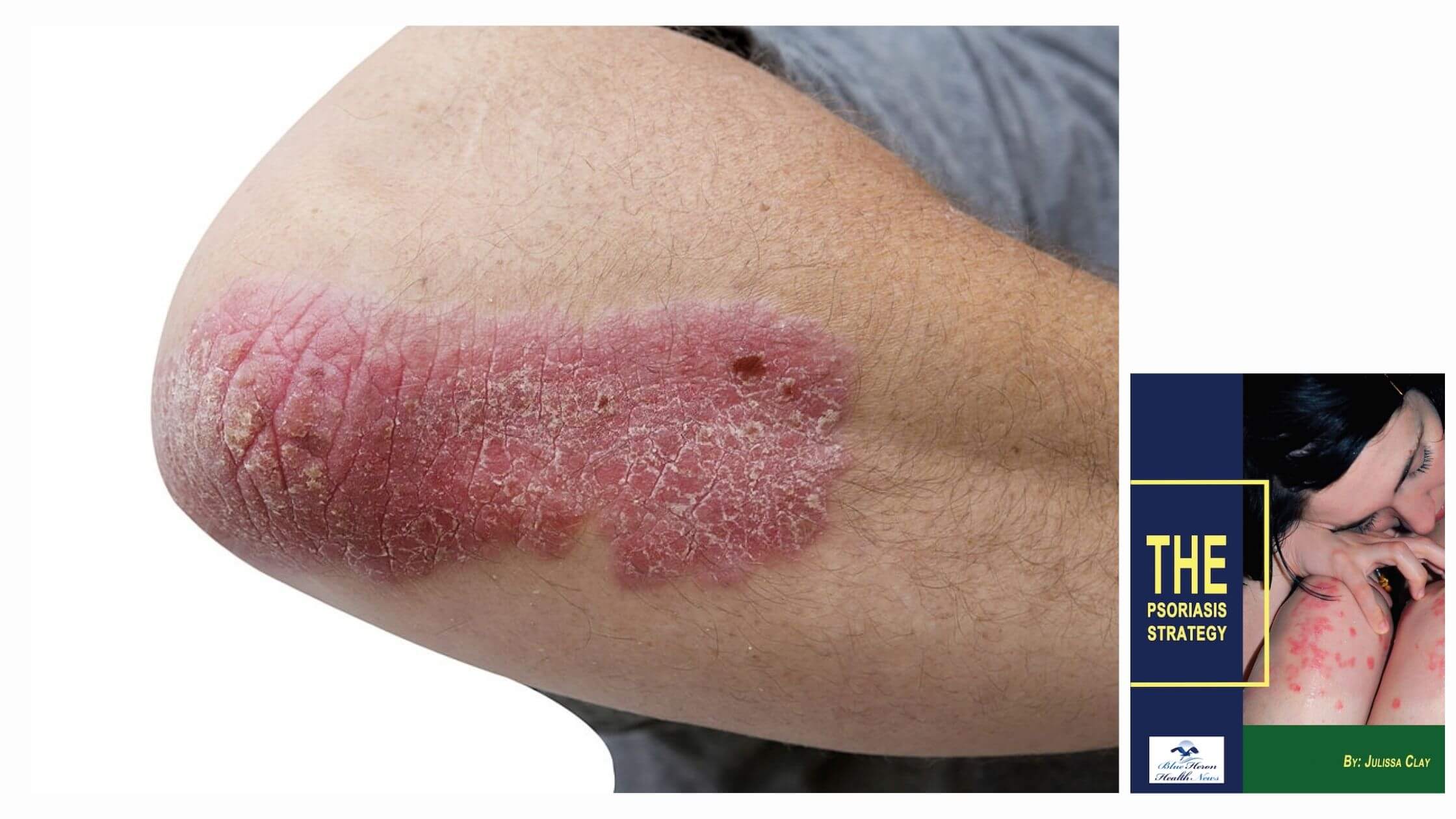 The Psoriasis Strategy Benefits