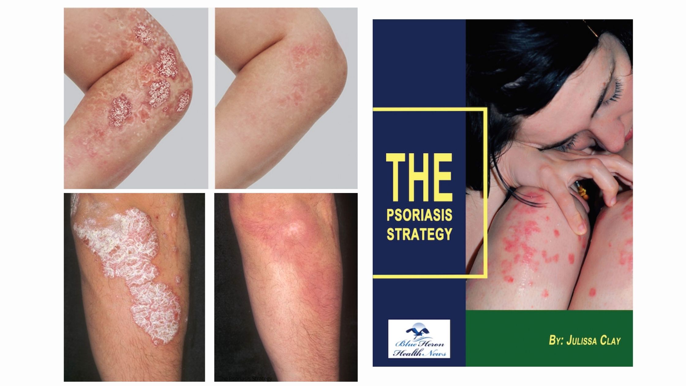 The Psoriasis Strategy Customer Reviews
