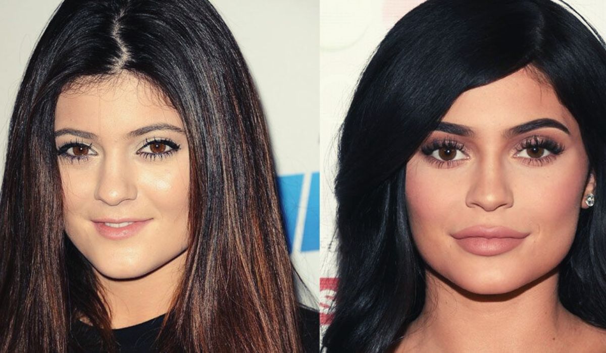 Kyli Jenner Lip Fillers